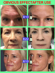 Wrinkles Disappear Become Beautiful Now